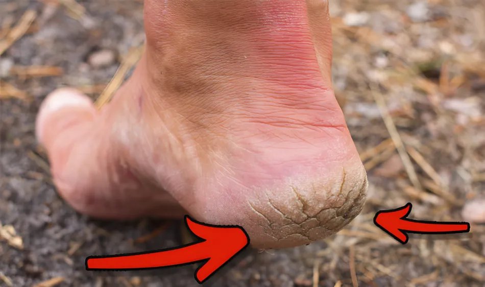 Foot Peel Mask vs. Pedicures & Other At-Home Treatments