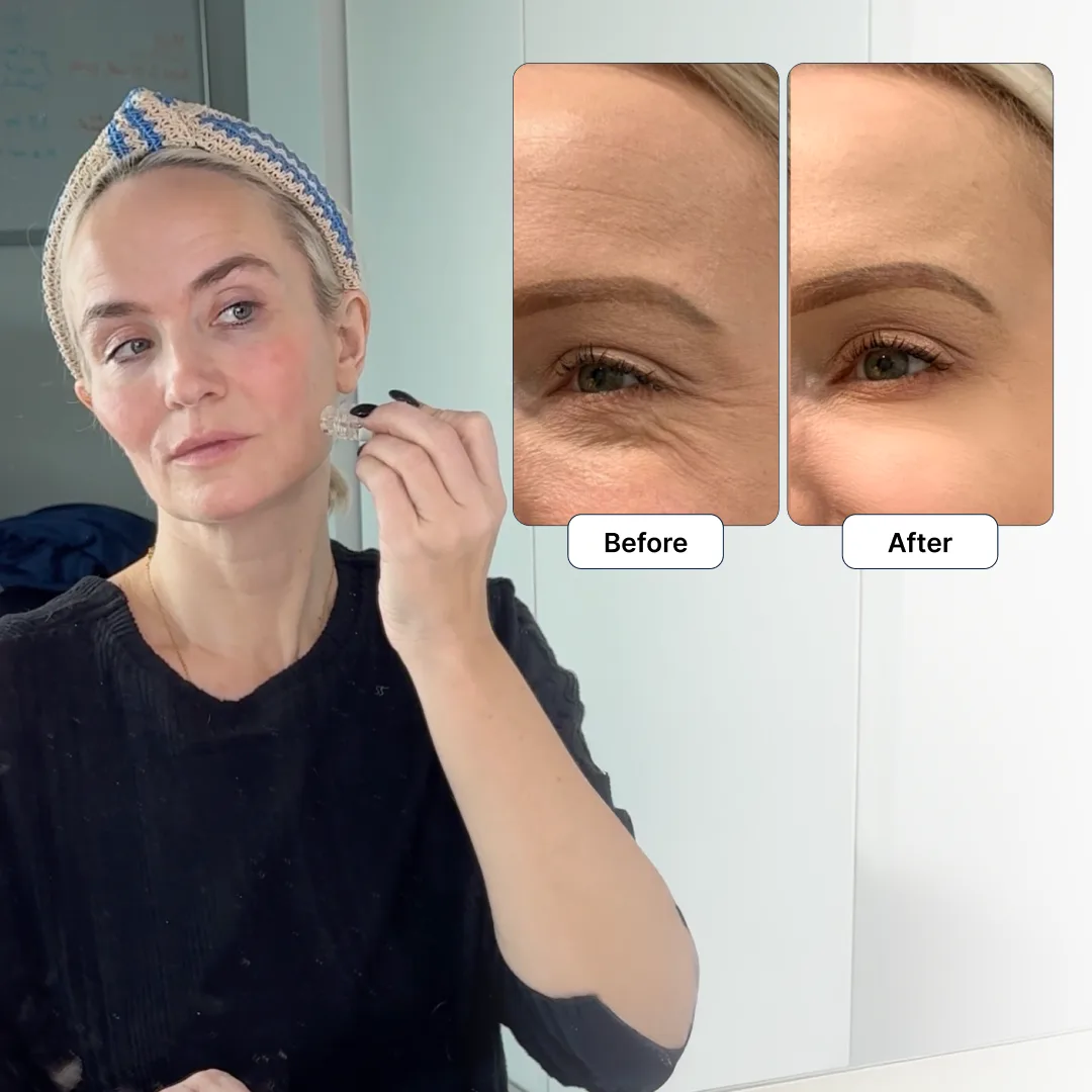 Woman using Glamory MicroLift device on her cheek with before-and-after inset
