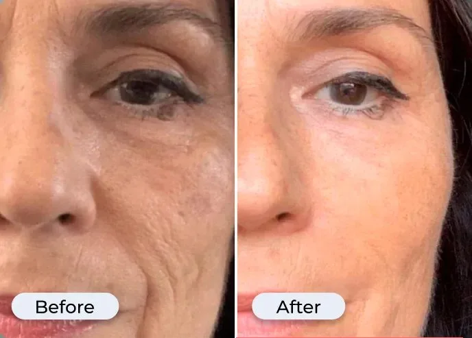 Before and after photo from Glamory's offer page showing under-eye skin
