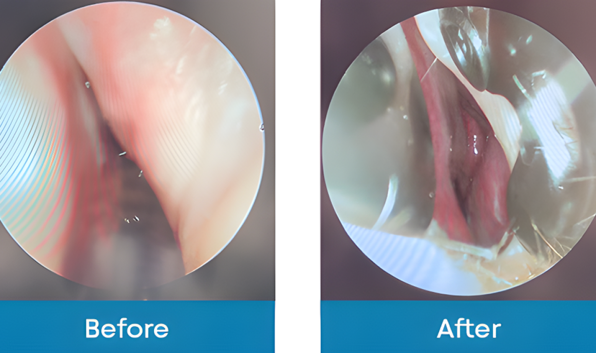 Before and after endoscopic views of nasal passages with and without the device
