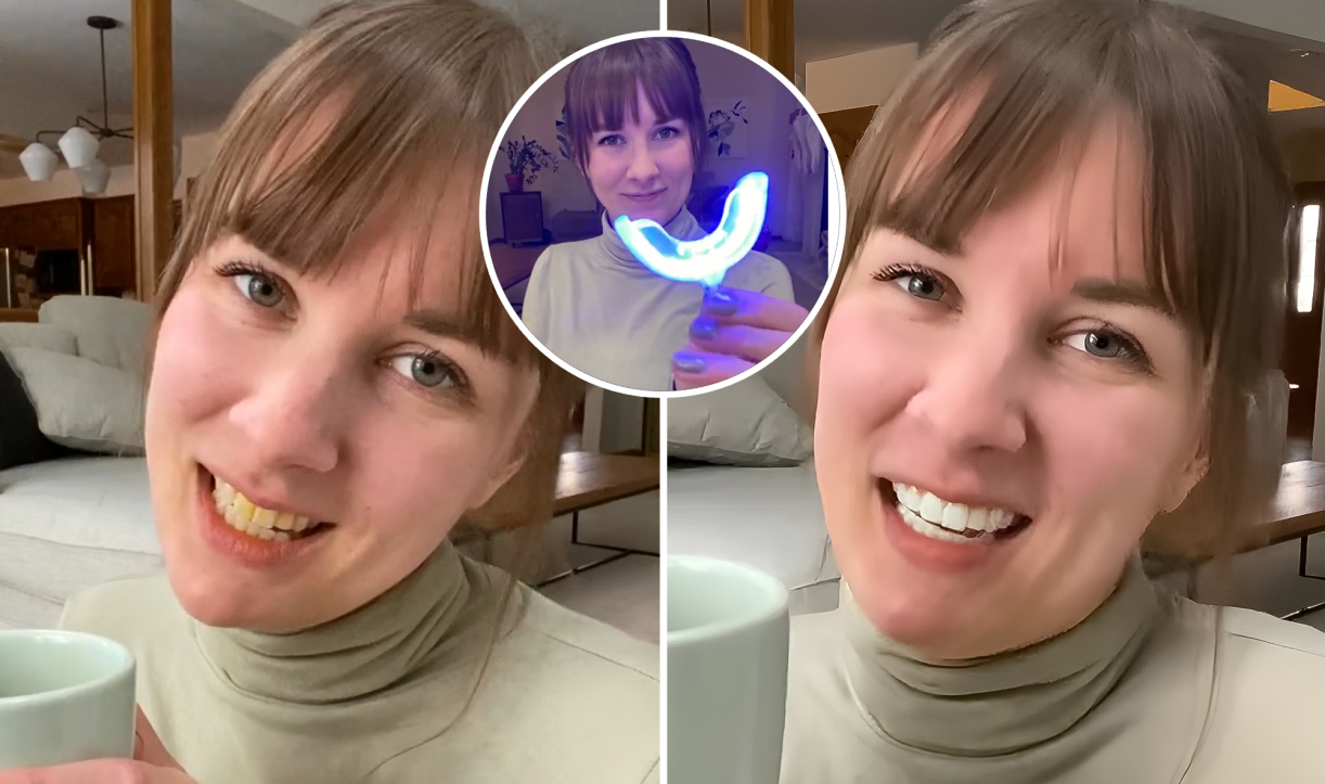 Woman smiling and using a blue light teeth whitening device