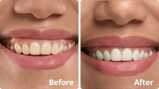 PurelyWHITE Deluxe vs. Whitening Strips