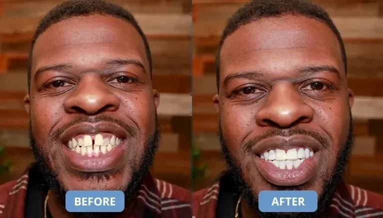 Wide product shot of Shiny Smile Veneers on a white background
